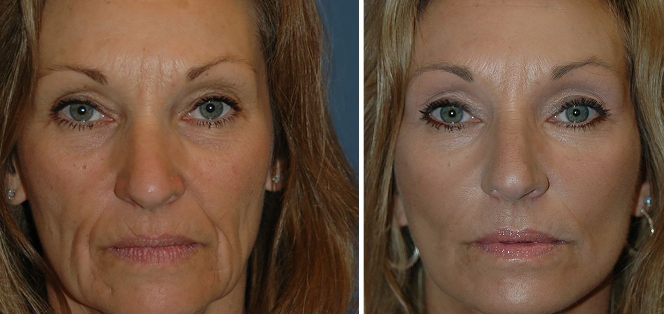 Before and After Facelifts. All healing stages and tips for a