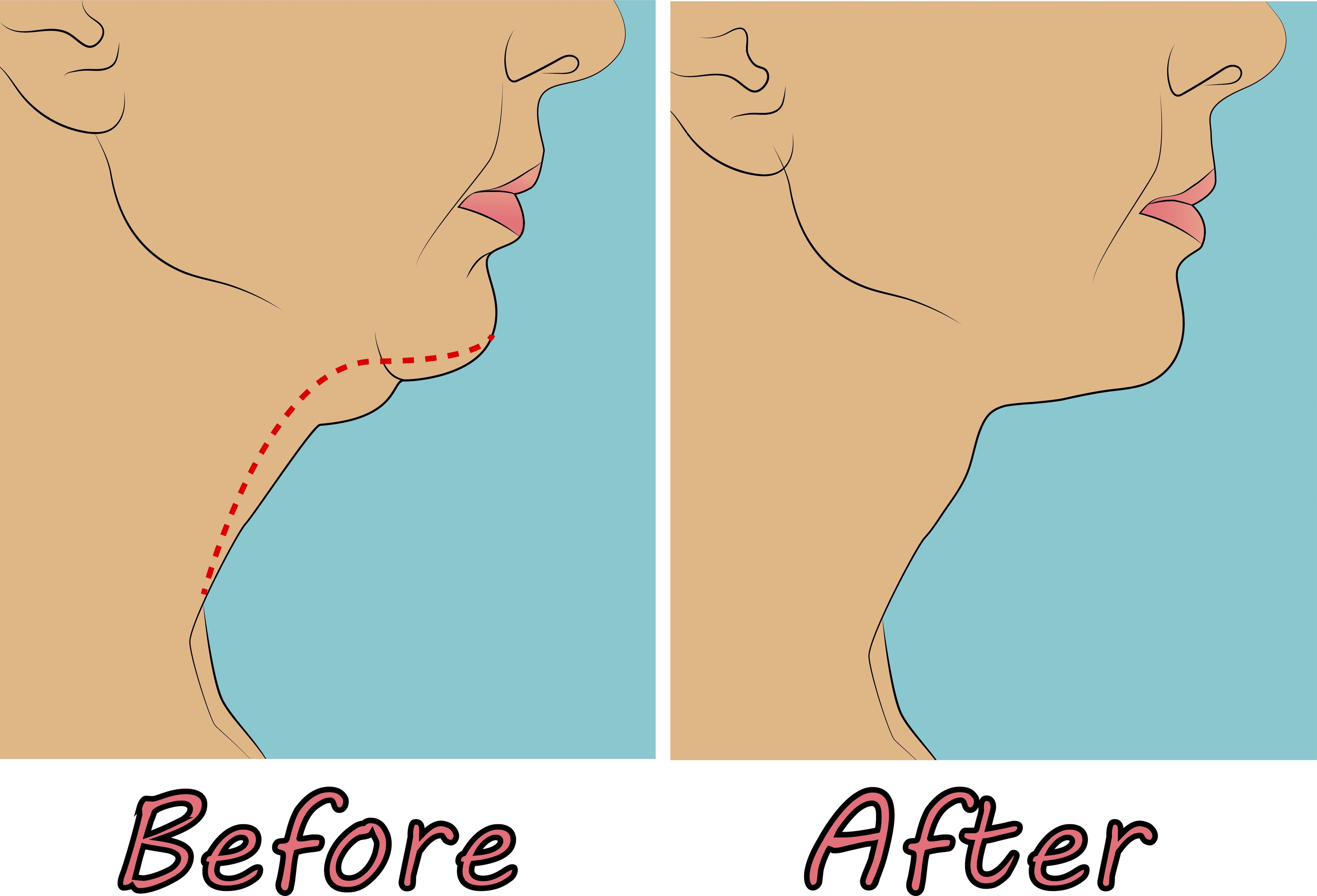 Procedure Double Chin Exercises