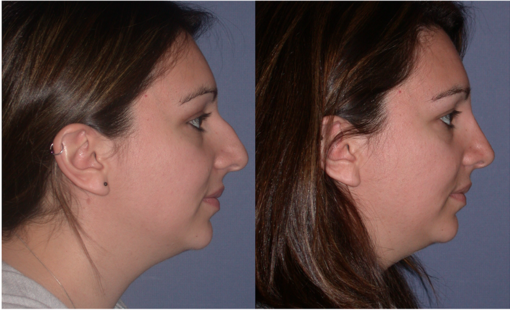 What Is Nasal Tip Rotation Facial Surgery Aesthetics Center