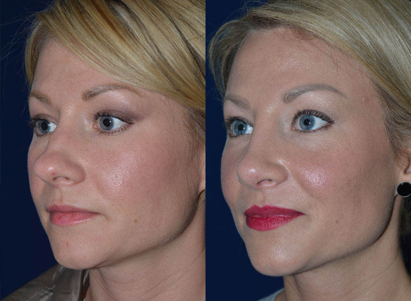 How To Fix A Wide Or Broad Nose Facial Surgery Aesthetics Center 